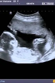 Fetal Heart Echography_peliplat