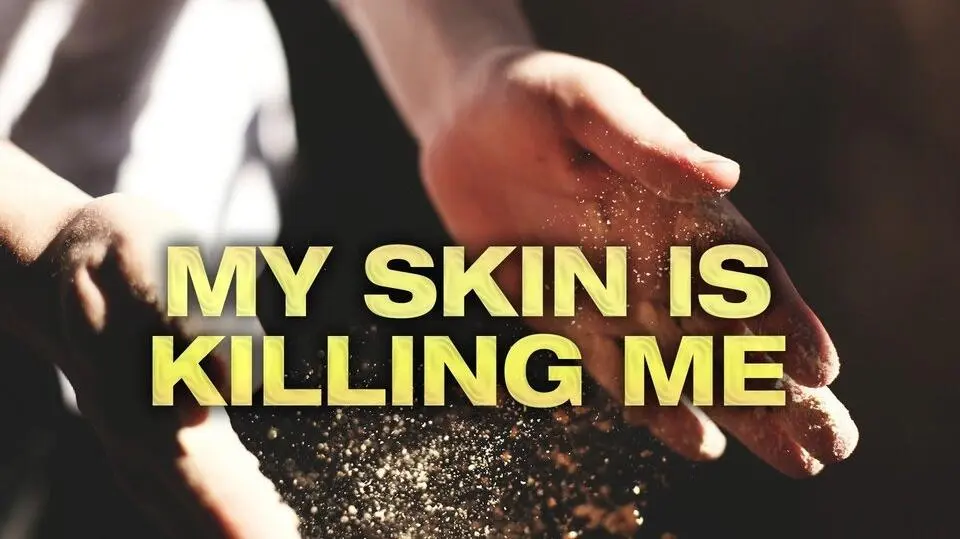 My Skin Is Killing Me_peliplat